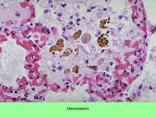 Hemosiderin
 