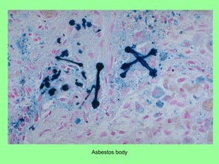 Asbestos body
 