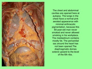 The chest and abdominal
cavities are opened here at
autopsy. The lungs in the
chest have a normal pink
aerated appearance with
minimal anthracotic
pigmentation, because this
80-year-old man never
smoked and never allowed
smoking in his workplace.
The mediastinum contains
mostly fat. The pericardial
sac around the heart has
not been opened.The
diaphragmatic domes
extend upward to the level
of the 6th ribs.
 