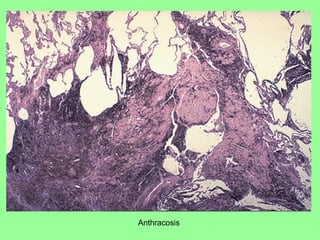 Anthracosis
 