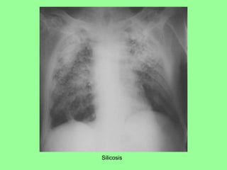 Silicosis
 