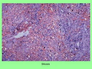 Silicosis
 