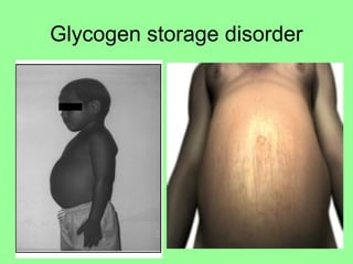 Glycogen storage disorder
 