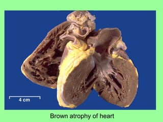 Brown atrophy of heart
 