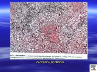 Caseation Hitopath Cell Injury, Adaptation And Accumulations | PPT