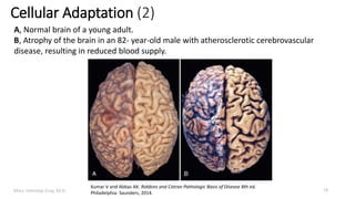 Marc Imhotep Cray, M.D.
Cellular Adaptation (2)
13
A, Normal brain of a young adult.
B, Atrophy of the brain in an 82- year-old male with atherosclerotic cerebrovascular
disease, resulting in reduced blood supply.
Kumar V and Abbas AK. Robbins and Cotran Pathologic Basis of Disease 8th ed.
Philadelphia: Saunders, 2014.
 