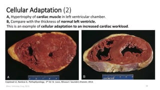 Marc Imhotep Cray, M.D.
Cellular Adaptation (2)
A, Hypertrophy of cardiac muscle in left ventricular chamber.
B, Compare with the thickness of normal left ventricle.
This is an example of cellular adaptation to an increased cardiac workload.
Copstead LC, Banksia JL. Pathophysiology, 5th Ed. St. Louis, Missouri: Saunders-Elsevier, 2013.
14
 