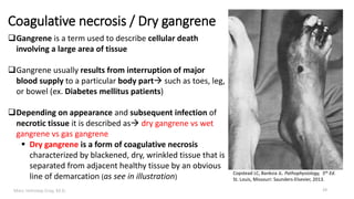 Marc Imhotep Cray, M.D.
Coagulative necrosis / Dry gangrene
Gangrene is a term used to describe cellular death
involving a large area of tissue
Gangrene usually results from interruption of major
blood supply to a particular body part such as toes, leg,
or bowel (ex. Diabetes mellitus patients)
Depending on appearance and subsequent infection of
necrotic tissue it is described as dry gangrene vs wet
gangrene vs gas gangrene
 Dry gangrene is a form of coagulative necrosis
characterized by blackened, dry, wrinkled tissue that is
separated from adjacent healthy tissue by an obvious
line of demarcation (as see in illustration)
Copstead LC, Banksia JL. Pathophysiology, 5th Ed.
St. Louis, Missouri: Saunders-Elsevier, 2013.
19
 