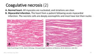 Marc Imhotep Cray, M.D.
Coagulative necrosis (2)
A. Normal heart. All myocytes are nucleated, and striations are clear.
B. Myocardial infarction. The heart from a patient following acute myocardial
infarction. The necrotic cells are deeply eosinophilic and most have lost their nuclei.
Rubin R and Strayer DS Eds. Rubin’s Pathology: Clinicopathologic Foundations of Medicine, 6th Ed. Baltimore: LLW, 2012
22
 