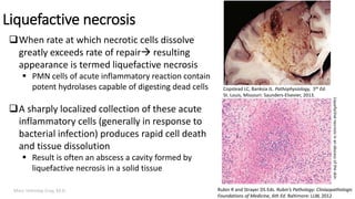 Marc Imhotep Cray, M.D.
Liquefactive necrosis
When rate at which necrotic cells dissolve
greatly exceeds rate of repair resulting
appearance is termed liquefactive necrosis
 PMN cells of acute inflammatory reaction contain
potent hydrolases capable of digesting dead cells
A sharply localized collection of these acute
inflammatory cells (generally in response to
bacterial infection) produces rapid cell death
and tissue dissolution
 Result is often an abscess a cavity formed by
liquefactive necrosis in a solid tissue
Liquefactivenecrosisinanabscessoftheskin.
Rubin R and Strayer DS Eds. Rubin’s Pathology: Clinicopathologic
Foundations of Medicine, 6th Ed. Baltimore: LLW, 2012
Copstead LC, Banksia JL. Pathophysiology, 5th Ed.
St. Louis, Missouri: Saunders-Elsevier, 2013.
24
 