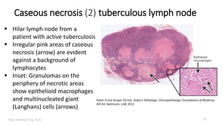 Marc Imhotep Cray, M.D.
Caseous necrosis (2) tuberculous lymph node
27
 Hilar lymph node from a
patient with active tuberculosis
 Irregular pink areas of caseous
necrosis (arrow) are evident
against a background of
lymphocytes
 Inset: Granulomas on the
periphery of necrotic areas
show epithelioid macrophages
and multinucleated giant
(Langhans) cells (arrows)
Rubin R and Strayer DS Eds. Rubin’s Pathology: Clinicopathologic Foundations of Medicine,
6th Ed. Baltimore: LLW, 2012
 