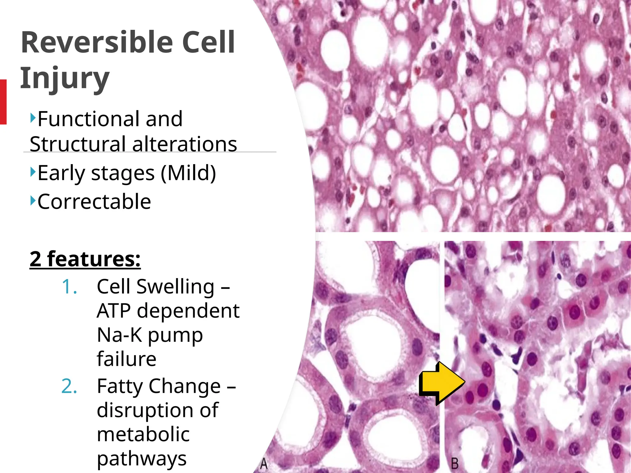 Reversible Cell
Injury
Functional and
Structural alterations
Early stages (Mild)
Correctable
2 features:
1. Cell Swelling –
ATP dependent
Na-K pump
failure
2. Fatty Change –
disruption of
metabolic
pathways
 