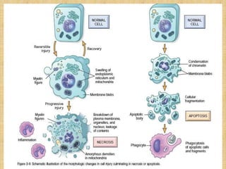 Cell injury causes and overview of cell injury and cell death lect 4 ...