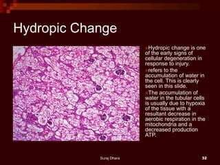 Hydropic Change
Hydropic change is one
of the early signs of
cellular degeneration in
response to injury.
refers to the
accumulation of water in
the cell. This is clearly
seen in this slide.
The accumulation of
water in the tubular cells
is usually due to hypoxia
of the tissue with a
resultant decrease in
aerobic respiration in the
mitochondria and a
decreased production
ATP.
Suraj Dhara 32
 