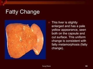 Fatty Change
 This liver is slightly
enlarged and has a pale
yellow appearance, seen
both on the capsule and
cut surface. This uniform
change is consistent with
fatty metamorphosis (fatty
change).
Suraj Dhara 33
 