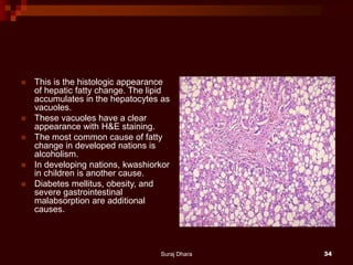  This is the histologic appearance
of hepatic fatty change. The lipid
accumulates in the hepatocytes as
vacuoles.
 These vacuoles have a clear
appearance with H&E staining.
 The most common cause of fatty
change in developed nations is
alcoholism.
 In developing nations, kwashiorkor
in children is another cause.
 Diabetes mellitus, obesity, and
severe gastrointestinal
malabsorption are additional
causes.
Suraj Dhara 34
 