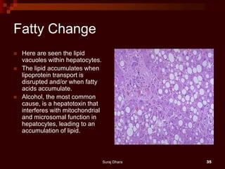 Fatty Change
 Here are seen the lipid
vacuoles within hepatocytes.
 The lipid accumulates when
lipoprotein transport is
disrupted and/or when fatty
acids accumulate.
 Alcohol, the most common
cause, is a hepatotoxin that
interferes with mitochondrial
and microsomal function in
hepatocytes, leading to an
accumulation of lipid.
Suraj Dhara 35
 