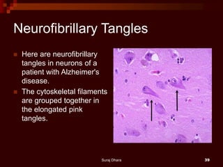 Neurofibrillary Tangles
 Here are neurofibrillary
tangles in neurons of a
patient with Alzheimer's
disease.
 The cytoskeletal filaments
are grouped together in
the elongated pink
tangles.
Suraj Dhara 39
 