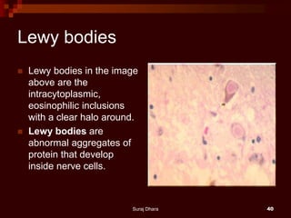 Lewy bodies
 Lewy bodies in the image
above are the
intracytoplasmic,
eosinophilic inclusions
with a clear halo around.
 Lewy bodies are
abnormal aggregates of
protein that develop
inside nerve cells.
Suraj Dhara 40
 