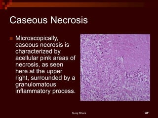 Caseous Necrosis
 Microscopically,
caseous necrosis is
characterized by
acellular pink areas of
necrosis, as seen
here at the upper
right, surrounded by a
granulomatous
inflammatory process.
Suraj Dhara 47
 
