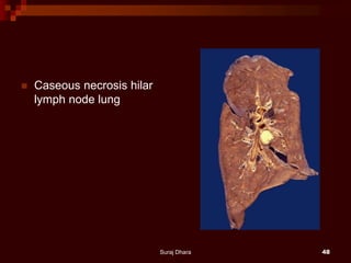  Caseous necrosis hilar
lymph node lung
Suraj Dhara 48
 