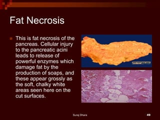 Fat Necrosis
 This is fat necrosis of the
pancreas. Cellular injury
to the pancreatic acini
leads to release of
powerful enzymes which
damage fat by the
production of soaps, and
these appear grossly as
the soft, chalky white
areas seen here on the
cut surfaces.
Suraj Dhara 49
 