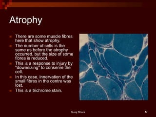 Atrophy
 There are some muscle fibres
here that show atrophy.
 The number of cells is the
same as before the atrophy
occurred, but the size of some
fibres is reduced.
 This is a response to injury by
"downsizing" to conserve the
cell.
 In this case, innervation of the
small fibres in the centre was
lost.
 This is a trichrome stain.
Suraj Dhara 5
 