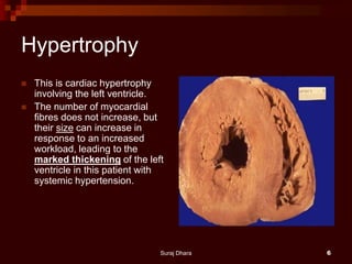 Hypertrophy
 This is cardiac hypertrophy
involving the left ventricle.
 The number of myocardial
fibres does not increase, but
their size can increase in
response to an increased
workload, leading to the
marked thickening of the left
ventricle in this patient with
systemic hypertension.
Suraj Dhara 6
 