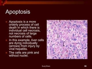 Apoptosis
 Apoptosis is a more
orderly process of cell
death in which there is
individual cell necrosis,
not necrosis of large
numbers of cells.
 In this example, liver cells
are dying individually
(arrows) from injury by
viral hepatitis.
 The cells are pink and
without nuclei.
Suraj Dhara 66
 