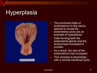 Hyperplasia
 The prominent folds of
endometrium in this uterus
opened to reveal the
endometrial cavity are an
example of hyperplasia.
 Cells forming both the
endometrial glands and the
stroma have increased in
number.
 As a result, the size of the
endometrium has increased.
 This increase is physiologic
with a normal menstrual cycle.
Suraj Dhara 7
 