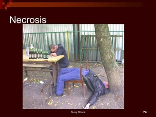 Necrosis
Suraj Dhara 74
 