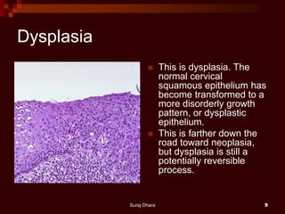Dysplasia
 This is dysplasia. The
normal cervical
squamous epithelium has
become transformed to a
more disorderly growth
pattern, or dysplastic
epithelium.
 This is farther down the
road toward neoplasia,
but dysplasia is still a
potentially reversible
process.
Suraj Dhara 9
 