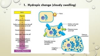 1. Hydropic change (cloudy swelling)
 
