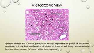 Hydropic change: this is due to paralysis of energy-dependent ion pumps of the plasma
membrane. It is the first manifestation of almost all forms of cell injury. Microscopically,
there are clear vacuoles (of water) within the cytoplasm.
MICROSCOPIC VIEW
 