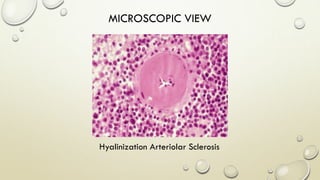 Hyalinization Arteriolar Sclerosis
MICROSCOPIC VIEW
 