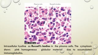 Intracellular hyaline as Russell’s bodies in the plasma cells. The cytoplasm
shows pink homogeneous globular material due to accumulated
immunoglobulins.
 