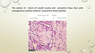 The centers of whorls of smooth muscle and connective tissue show pink
homogeneous hyaline material (connective tissue hyaline)
 