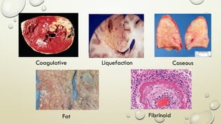 Coagulative Liquefaction Caseous
Fat Fibrinoid
 