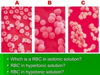 Which is a RBC in isotonic solution?
 RBC in hypertonic solution?
 RBC in hypotonic solution?
 
