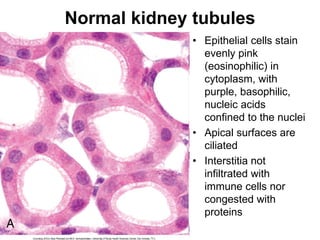 Normal kidney tubules
• Epithelial cells stain
evenly pink
(eosinophilic) in
cytoplasm, with
purple, basophilic,
nucleic acids
confined to the nuclei
• Apical surfaces are
ciliated
• Interstitia not
infiltrated with
immune cells nor
congested with
proteins
 