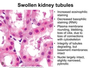 Swollen kidney tubules
• Increased eosinophilic
staining
• Decreased basophilic
staining (RNA)
• Plasma membrane
rounding, blebbing,
loss of cilia, due to
loss of connections
with cytoskeleton
• Integrity of tubules
degrading, but
basement membranes
intact
• Nuclei largely intact,
slightly narrowed,
pyknotic
 