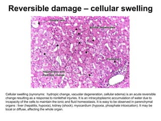 Reversible damage – cellular swelling
Cellular swelling (synonyms: hydropic change, vacuolar degeneration, cellular edema) is an acute reversible
change resulting as a response to nonlethal injuries. It is an intracytoplasmic accumulation of water due to
incapacity of the cells to maintain the ionic and fluid homeostasis. It is easy to be observed in parenchymal
organs : liver (hepatitis, hypoxia), kidney (shock), myocardium (hypoxia, phosphate intoxication). It may be
local or diffuse, affecting the whole organ.
 