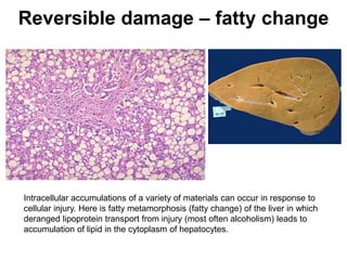 Reversible damage – fatty change
Intracellular accumulations of a variety of materials can occur in response to
cellular injury. Here is fatty metamorphosis (fatty change) of the liver in which
deranged lipoprotein transport from injury (most often alcoholism) leads to
accumulation of lipid in the cytoplasm of hepatocytes.
 