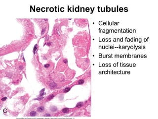 Necrotic kidney tubules
• Cellular
fragmentation
• Loss and fading of
nuclei--karyolysis
• Burst membranes
• Loss of tissue
architecture
 