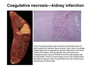 Coagulative necrosis—kidney infarction
This is the typical pattern with ischemia and infarction (loss of
blood supply and resultant tissue anoxia). Here, there is a wedge-
shaped pale area of coagulative necrosis (infarction) in the renal
cortex of the kidney. Microscopically, the renal cortex has
undergone anoxic injury at the left so that the cells appear pale
and ghost-like. There is a hemorrhagic zone in the middle where
the cells are dying or have not quite died, and then normal renal
parenchyma at the far right.
 