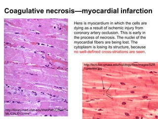 Coagulative necrosis—myocardial infarction
Here is myocardium in which the cells are
dying as a result of ischemic injury from
coronary artery occlusion. This is early in
the process of necrosis. The nuclei of the
myocardial fibers are being lost. The
cytoplasm is losing its structure, because
no well-defined cross-striations are seen.
http://bcrc.bio.umass.edu/histology/files/images/SZR
1.preview.jpg
http://library.med.utah.edu/WebPath/CINJHT
ML/CINJ013.html
 
