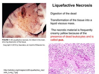 Digestion of the dead
Transformation of the tissue into a
liquid viscous mass.
The necrotic material is frequently
creamy yellow because of the
presence of dead leukocytes and is
called pus.
Liquefactive Necrosis
http://wikidoc.org/images/c/c8/Liquefactive_necr
osis_Lung_7.jpg
 
