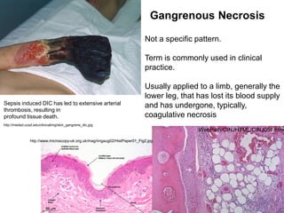 Not a specific pattern.
Term is commonly used in clinical
practice.
Usually applied to a limb, generally the
lower leg, that has lost its blood supply
and has undergone, typically,
coagulative necrosis
Gangrenous Necrosis
http://meded.ucsd.edu/clinicalimg/skin_gangrene_dic.jpg
Sepsis induced DIC has led to extensive arterial
thrombosis, resulting in
profound tissue death.
http://www.microscopy-uk.org.uk/mag/imgaug02/HistPaper01_Fig2.jpg
WebPath/CINJHTML/CINJ051.htm
 