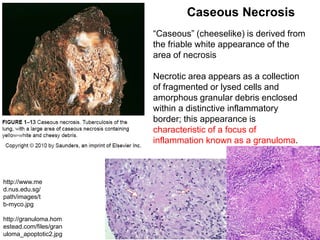 “Caseous” (cheeselike) is derived from
the friable white appearance of the
area of necrosis
Necrotic area appears as a collection
of fragmented or lysed cells and
amorphous granular debris enclosed
within a distinctive inflammatory
border; this appearance is
characteristic of a focus of
inflammation known as a granuloma.
Caseous Necrosis
http://granuloma.hom
estead.com/files/gran
uloma_apoptotic2.jpg
http://www.me
d.nus.edu.sg/
path/images/t
b-myco.jpg
 