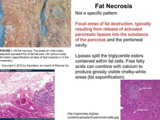 Not a specific pattern
Focal areas of fat destruction, typically
resulting from release of activated
pancreatic lipases into the substance
of the pancreas and the peritoneal
cavity.
Lipases split the triglyceride esters
contained within fat cells. Free fatty
acids can combine with calcium to
produce grossly visible chalky-white
areas (fat saponification).
Fat Necrosis
http://pancreas.org/wp-
content/uploads/nl-pancreas-cells.jpg
 